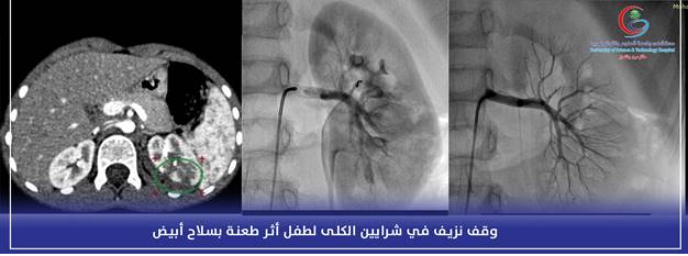 إثر تعرضه لطعنة >>